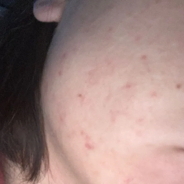 What would you recommend for post acne scars?
