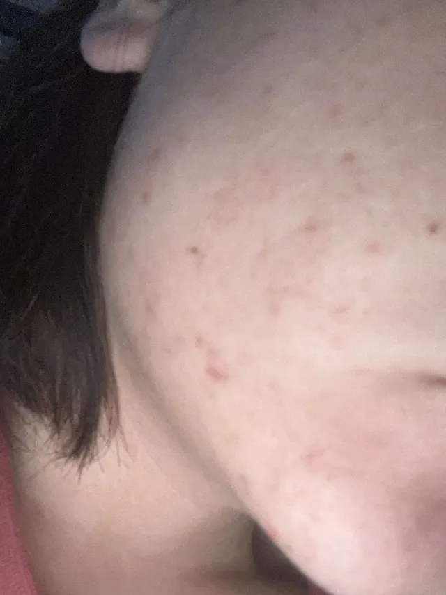 What would you recommend for post acne scars?
