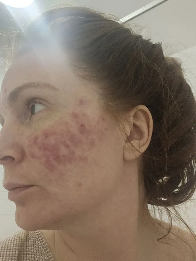 Adult acne.....my doctor says it's my thyroid issue, I think